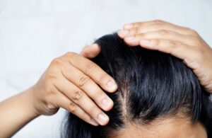 imagen de caída de pelo en mujeres