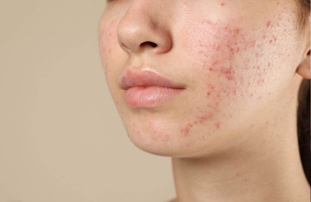 que es el acné hormonal, imagen de ejemplo