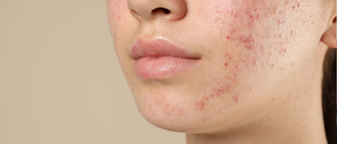 que es el acné hormonal, imagen de ejemplo